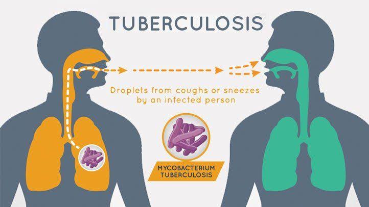 Biggest tuberculosis outbreak in Washington state